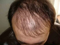 Seyrek Saçlar Belirtileri ve Tedavisi